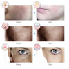Mascara Facial LED Recargable de Fotonterapia